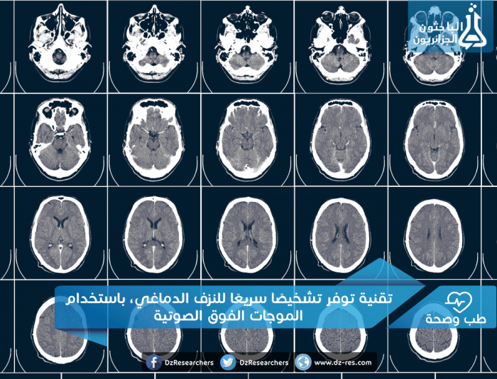 توفر تشخيصًا سريعًا للنزف الدماغي، باستخدام الموجات الفوق الصوتية e1467095233795