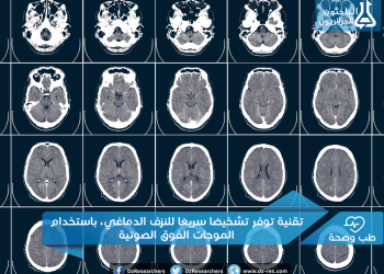 توفر تشخيصًا سريعًا للنزف الدماغي، باستخدام الموجات الفوق الصوتية e1467095233795