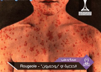 الحصبة  “البوحمرون ” Rougeole