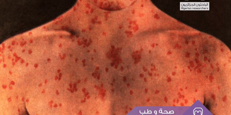الحصبة  “البوحمرون ” Rougeole