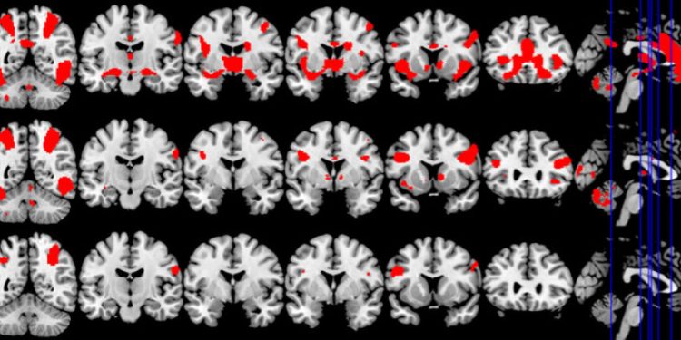 هل يتشابه نشاط الدماغ لدى كل من مدمني الجنس ومدمني المخدرات؟
