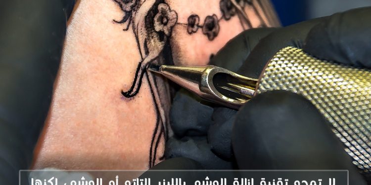 هل تعلم؟  تقنية إزالة الوشم بالليزر
